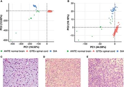 Transcriptomic Portraits and Molecular Pathway Activation Features of Adult Spinal Intramedullary Astrocytomas